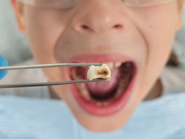 Best Emergency Root Canal Treatment in Cascade, IA